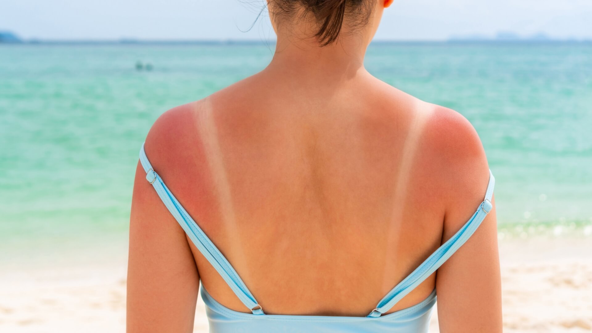 First Aid for Sunburn: How to Treat and Prevent Sunburn at Home | CPR1