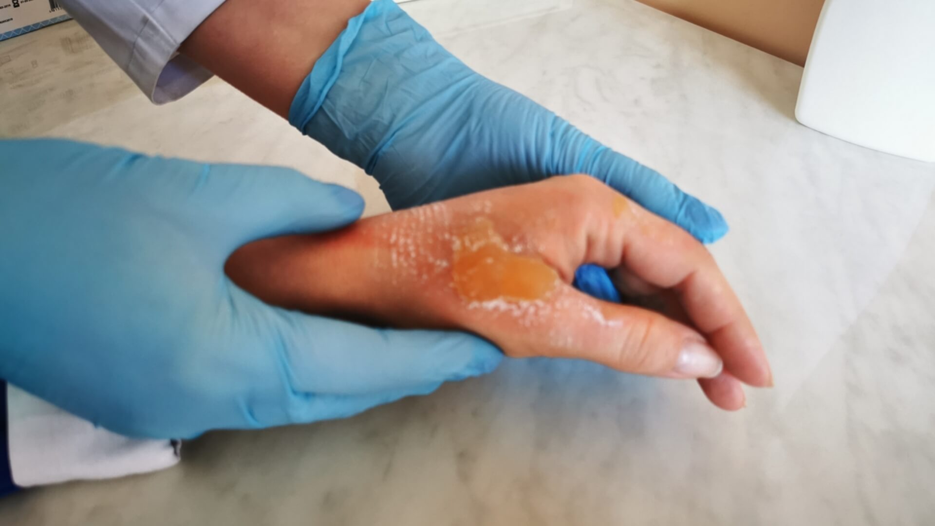 Hot Water Burn Treatment First Aid for Scalding Injuries | CPR1