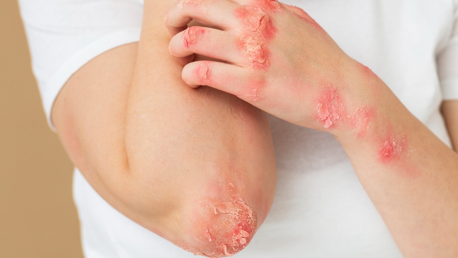 Types of Burns Identifying and Treating Each Effectively | CPR1