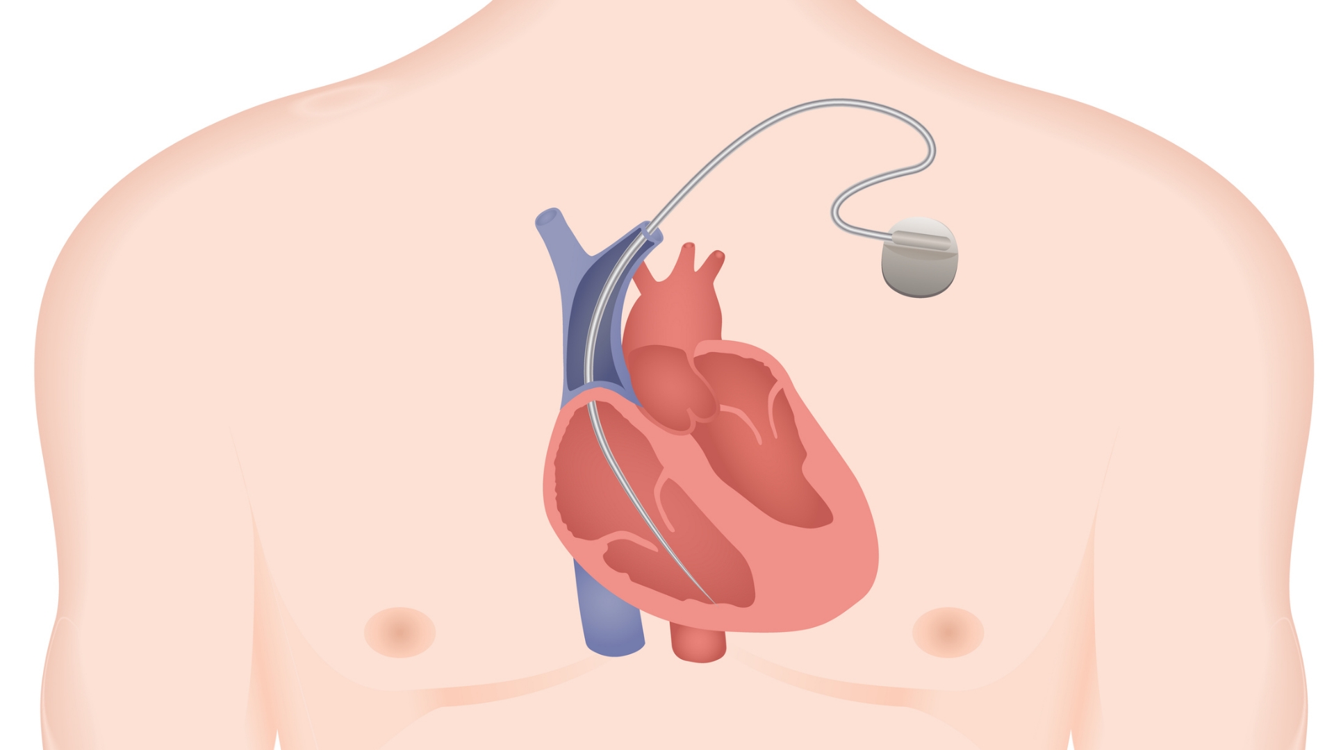 Pacemaker vs Defibrillator Key Differences You Should Know | CPR1
